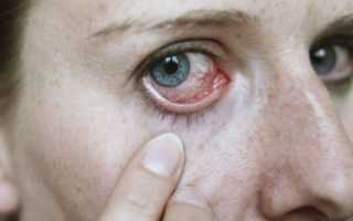 Демодекоз глаз: демодекозный блефарит и блефароконъюнктивит. Симптомы и лечение