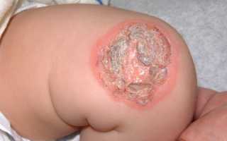 Классификация импетиго, особенности течения и лечение заболевания у детей