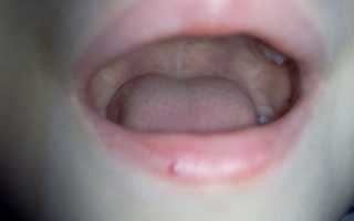 Причины появления родинки на губе и методы устранения
