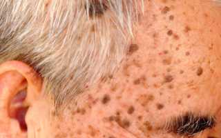Виды и способы удаления кератомы – доброкачественной опухоли кожи