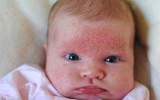 Особенности лечения и виды стрептодермии на лице