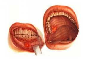 Как лечить ожог слизистой рта?