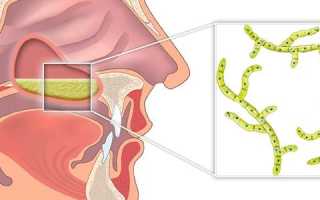 Симптомы микоза носоглотки и тактика лечения заболевания