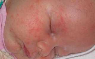 Отличие потницы от аллергии у грудного ребенка и как ее избежать