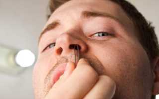 Лечение сикоза носа