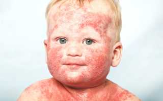 Особенности использования эмолентов при терапии атопического дерматита у ребенка