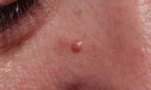 Причины возникновения и виды папулезной сыпи на коже