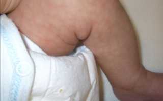 Особенности мраморности кожи у грудничков