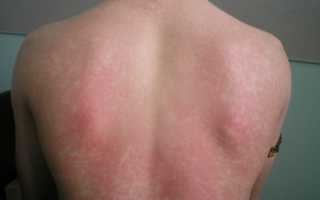 Симптомы и лечение различных видов аллергического дерматита у взрослых и детей