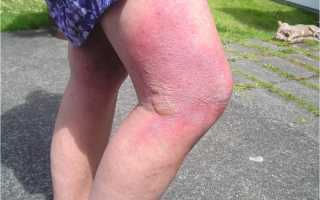 Причины появления дерматита на ногах и его терапия
