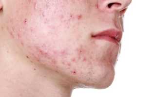 Причины развития демодекоза на лице, его лечение