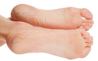 Разновидности наростов на пальцах ног и как от них избавиться