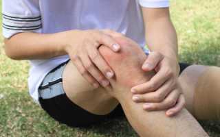 Возможные причины появления синяков на коленях и их лечение