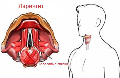 Признаки ларингита Признаки ларингита