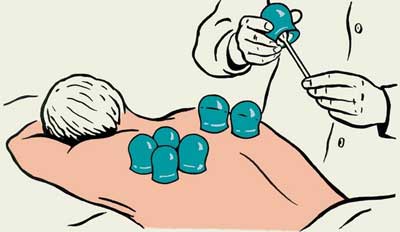 банки при бронхите банки при воспалении