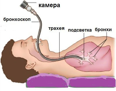 Проведение бронхоскопии Проведение бронхоскопии