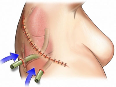 Операцция по торакотомии Операцция по торакотомии