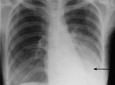 Затемнение легких на рентгене Затемнение легких на рентгене