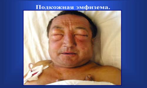 slide-13 Подкожная эмфизема представляет собой скопление воздуха в органах или тканях