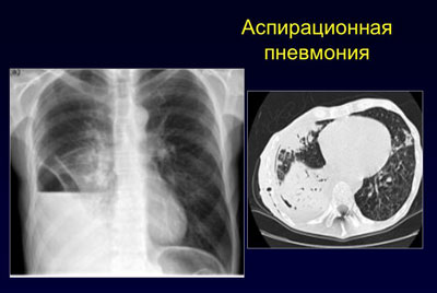 Аспирационная пневмония на рентгене Аспирационная пневмония на рентгене