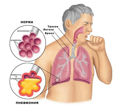 Кашель при пневмонии Кашель при пневмонии